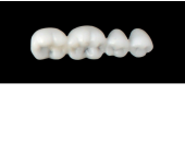 Cod.E2LOWER LEFT: 15x  posterior hollow wax veneers-bridges, MEDIUM, (34-37), with precarved occlusion to Cod.E2UPPER LEFT, and compatible to Cod.S2LOWER LEFT (solid), (34-37)